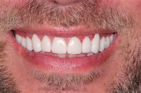 Say Goodbye to Dental Imperfections with Magic Smile Midtown